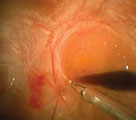 retina surgery